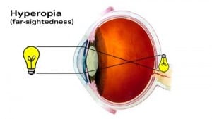 Hyperopia.jpg - Laramy-K Independent Optical Lab - Freeform Lenses And ...